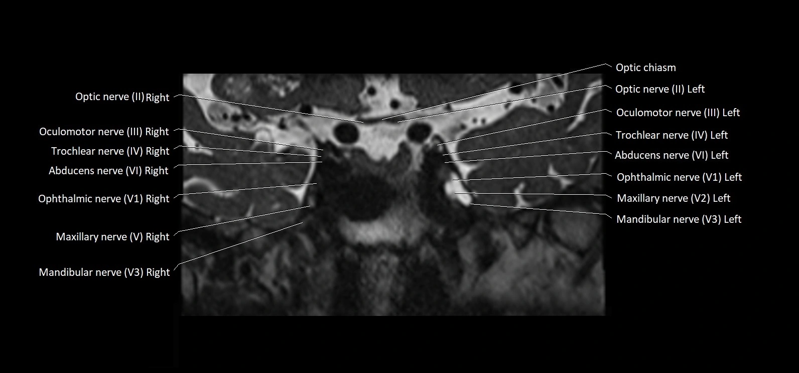 Cranial nerve cross sectional anatomy coronal 3T MRI image 27.webp